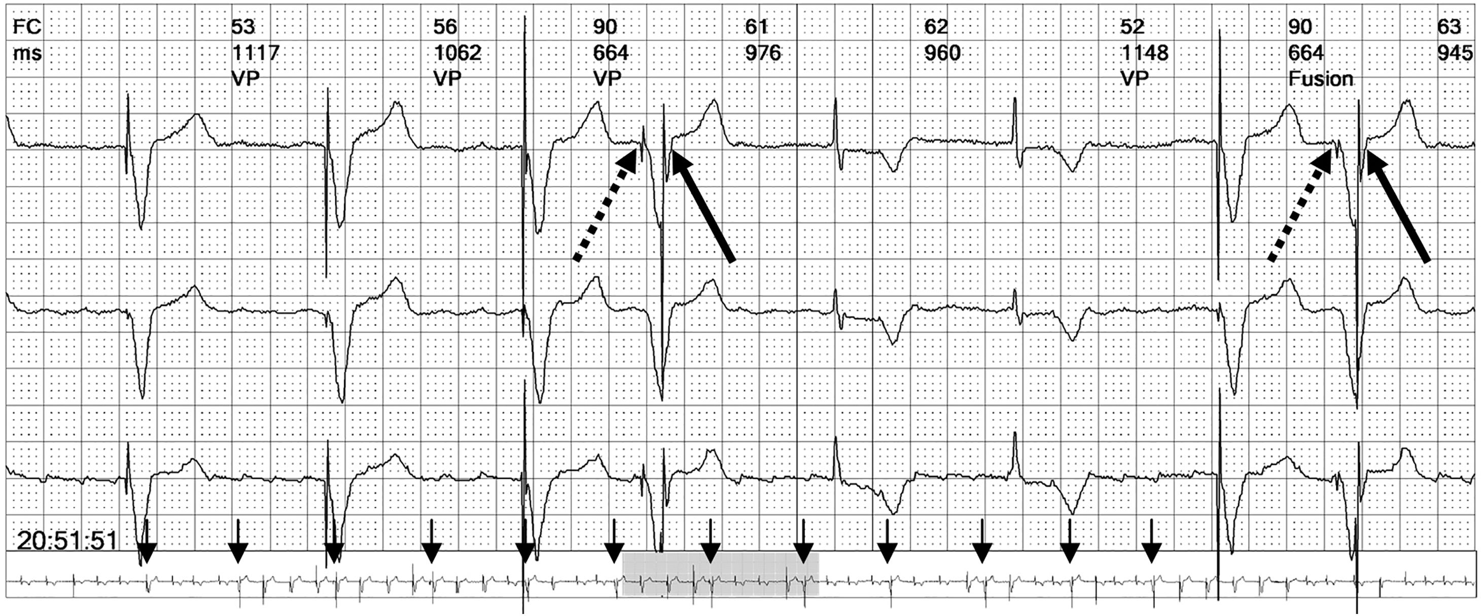 Advanced pacing algorithms resembling device malfunction: A ...