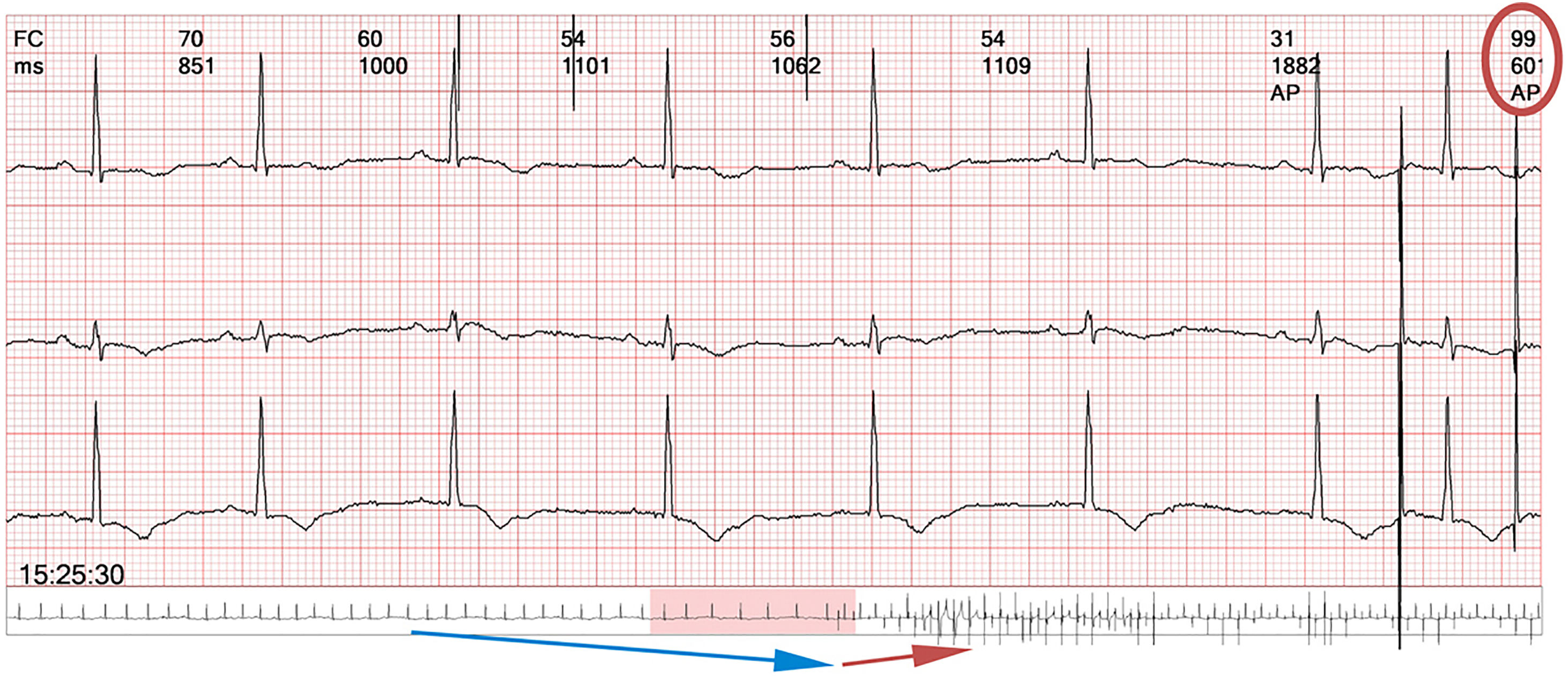 Advanced pacing algorithms resembling device malfunction: A ...