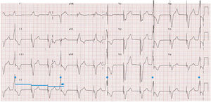 Triggered ventricular pacing. The patient had a cardiac resynchronization therapy functioning in VVIR mode at ∼70bpm with high density ventricular premature beats (asterisks). The cardiac resynchronization therapy responded to sensing of every ventricular premature beat by pacing from the left ventricular lead: this triggered pacing occurs, therefore, earlier than expected (arrow). Reproduced with permission from Fernández-Vega et al.26