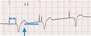 Sorin WARAD. This algorithm prevents and recognizes atrial arrhythmia. After an atrial premature contraction (arrow), the atrium is paced after 500ms regardless of the programmed lower rate limit, and the ventricle is paced after 80ms (shortest exercise atrioventricular interval).