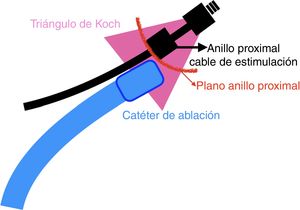 Esquema representativo (proyección OAD) de la ablación del nódulo auriculoventricular con cable de estimulación hisiana.