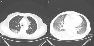 A) Tomografía axial computarizada torácica con opacidades parcheadas en vidrio deslustrado, en lóbulo superior derecho, de un paciente con COVID-19. B) Marcado derrame pleural bilateral de predominio derecho, cardiomegalia, y en la ventana de parénquima pulmonar se observa un patrón en vidrio deslustrado bilateral y simétrico, con engrosamiento de septos pulmonares, altamente sugestivo de edema intersticial con componente alveolar incipiente por insuficiencia cardiaca descompensada.