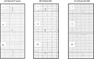 P wave patterns. (A) Normal P wave: P wave<120ms regradless of morphology. (B) Partial interatrial block (IAB): P wave≥120ms without bimodal morphology. (C) Advanced IAB: P wave≥120ms without bimodal morphology.