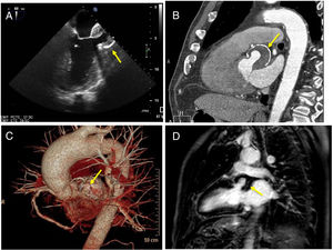 A) Ecografía transesofágica, plano medio esofágico de 2 cámaras donde se observa una cavidad con cuello estrecho que comunica con el ventrículo izquierdo compatible con seudoaneurisma ventricular con trombo mural en su interior (flecha). B) Reconstrucción curvilínea de la tomografía computarizada (TC) cardiaca donde se confirma la presencia de un seudoaneurisma en el ventrículo izquierdo con trombo mural en su interior y calcificación de su pared (flecha). C) Reconstrucción volumétrica de la TC cardiaca donde se muestra el seudoaneurisma (flecha) y su localización respecto a la raíz de la aorta y el origen del árbol coronario izquierdo. D) Resonancia cardiaca, secuencia de realce tardío, en la que no se observa retención de contraste en la pared del seudoaneurisma (flecha).
