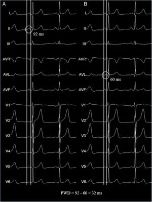 Panels A and B show identical electrocardiographic traces taken from a healthy patient to exemplify the PWD measurement technique using a 12-lead simultaneous recording and hand-held caliper. Pmax and Pmin were measured in the same beat to avoid the phenomenon of P wave lability over time. The measurements were made with a sweep speed of 50mm/s and amplification of 20mm/mV. Pmax, maximum P wave duration; Pmin, minimum P duration; PWD, P wave dispersion.
