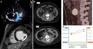 Algoritmo diagnóstico de la disfunción ventricular grave por feocromocitoma. A) Miocardiopatía dilatada de novo con insuficiencia mitral funcional grave. Además, en la resonancia magnética cardiaca se observa el realce tardío compatible con infarto. B) Crecimiento de la masa retroperitoneal. C) Tomografía por emisión de positrones. D) Niveles de las metanefrinas.