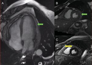 A)Resonancia magnética cardiaca en secuencia T2 en proyección de 4 cámaras que muestra una colección pericárdica de hasta 18mm en la cara lateral izquierda (flecha verde), con intensidad de señal intermedia y zonas heterogéneas. B)Imagen del derrame en eje corto. C)Imagen del llamativo realce tardío de las hojas pericárdicas tras la administración de gadolinio, sugerente de inflamación de las mismas (flecha amarilla).