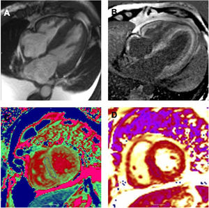Amiloidosis cardiaca. A) Secuencia cine en 4 cámaras donde se objetiva hipertrofia biventricular, dilatación biauricular y engrosamiento de septo interauricular junto con derrame pleural bilateral. B) Secuencia de realce tardío. Se objetiva realce subendocárdico de forma global en ambos ventrículos y biauricular. C) Secuencia de mapeo T1 nativo. Valor en septo interventricular medio de 1.219ms (valores normales 932-1.053ms). D) Secuencia de mapeo T2. Valor en septo interventricular medio de 47ms (valores normales 44-57ms).