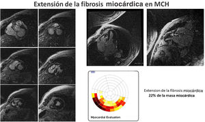 Realce tardío de gadolinio en un paciente con miocardiopatía hipertrófica. Se observa una extensa fibrosis miocárdica que se cuantifica del 22% con respecto a la masa miocárdica. Este hallazgo conlleva un alto riesgo arrítmico y apoya la indicación de implante de un desfibrilador automático implantable en prevención primaria.