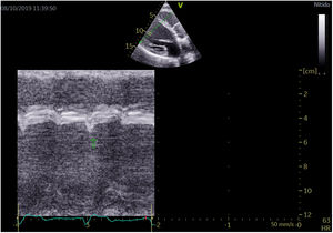 Septal flash identified on 2D gray scale images and color M-mode.