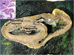 Transverse section of the left and right ventricles (human heart). The black arrows indicate the direction of motion of each segment during systole. The yellow arrow indicates the plane of friction between both segments. Anterior septal band (1); posterior septal band (2); intraseptal band (3). The histology in the inset shows the different orientation of the longitudinal fibers (ascending segment) in relation to the transverse fibers (descending segment). LV: left ventricle; RV: right ventricle.