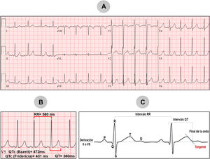 A) Electrocardiograma de 12 derivaciones de una niña de 5 años, referida por un intervalo QT prolongado. B) Magnificación de la derivación V5 con medición del intervalo QTc (472ms por fórmula de Bazett y 431ms por fórmula de Fridericia). C) Método de la tangente para obtener el intervalo QT; gráfico elaborado con datos de Vink33.