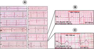 A) Electrocardiograma de 12 derivaciones de un niño de 5 años, referido por antecedente de síncope. B) Magnificación de la derivación V5 con medición del intervalo QTc (489ms por la fórmula de Bazett y 499ms por la de Fridericia). C) Magnificación de la derivación V6 con medición del intervalo QTc (451ms por la fórmula de Bazett y 461ms por la de Fridericia).