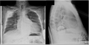 Posteroanterior and lateral chest X-ray showing cardiac contractility modulator and subcutaneous implantable cardioverter defibrillator devices in optimal position.