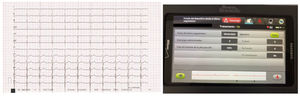 Electrocardiogram during cardiac contractility modulator stimulation (left) and subcutaneous implantable cardioverter defibrillator interrogation without noise detection (right).
