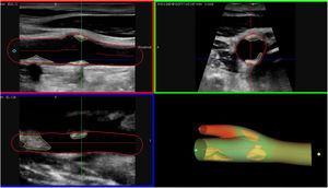 Ecografía 3D de la carótida derecha con imagen multiplanar y modelo 3D. Se puede apreciar la segmentación de las placas ateroscleróticas y del contorno de la pared del vaso.