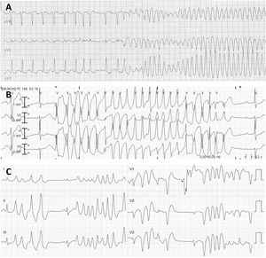 Trazados de distintos tipos de taquicardia ventricular polimórfica. A: Paciente con isquemia aguda. B: Paciente con síndrome de QT largo de origen. C: Paciente con cardiopatía isquémica en fase estable, con extrasistolia ventricular con acoplamiento corto que provoca de forma repetitiva una taquicardia ventricular polimórfica.