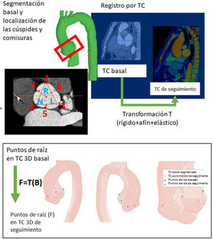 Corregistro de diferentes estudios de tomografía computarizada (TC) en un mismo paciente; y obtención del mapa de deformación vascular con el fin de valorar las regiones con mayor crecimiento (zonas más claras).