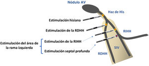 Distintas modalidades de estimulación fisiológica en función de la localización del electrodo. AV: auriculoventricular; RDHH: rama derecha del haz de His; RIHH: rama izquierda del haz de His; SIV: septo interventricular.