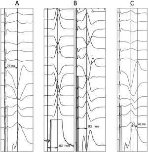 Criterios complementarios de validación de captura de rama izquierda del haz de His (RIHH). A: tiempo de activación del ventrículo izquierdo (LVAT) desde el potencial de RIHH y LVAT desde la espiga de estimulación. B: LVAT. C: tiempo interpico V6 y V1.