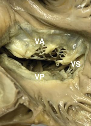 Pieza de necropsia de un paciente con insuficiencia tricuspídea atriogénica. VA: velo anterior; VP: velo posterior; VS: velo septal.