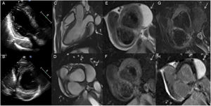 Lipoma cardiaco. Ecocardiografía transtorácica (ETT): masa hipoecogénica adyacente al epicardio de la pared inferior e inferolateral basal del ventrículo izquierdo y aurícula izquierda (A,B). Resonancia magnética (RM) (C-H): secuencias de cine (C-D). En T1w se aprecia hiperintensidad de señal respecto al miocardio (E) que desaparece con prepulsos de saturación grasa (F). El tumor es hipointenso en la secuencia T2w-saturación grasa G (G) e hiperintenso en la secuencia de RTG aunque no por retención de gadolinio sino por su naturaleza lipídica (H).