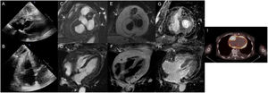 Metástasis de linfoma. Ecocardiografía transtorácica: estructura hiperecogénica que tapiza el ventrículo derecho y aurícula derecha asociada a ligero derrame pericárdico (A,B). Resonancia magnética (RM) (C-H): lesión infiltrante a nivel de las cavidades derechas (engloba la coronaria derecha) (C,D), hiperintensa en secuencia de sangre negra potenciada en T2 (E,F) y sin realce tardío de gadolinio (G,H). La masa muestra intensa actividad metabólica en la tomografía de emisión de positrones (PET) (I).