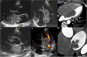 Caracterización de un mixoma mediante ecocardiografía transtorácica (ETT) y tomografía computarizada (TC). ETT: masa a nivel de la AI, que prolapsa a través de la válvula mitral (A-D). El estudio Doppler color (D) mostró aceleración de flujo transvalvular (se estimó con Doppler continuo un gradiente medio de 14mmHg). TC: el tumor presenta baja atenuación en comparación miocardio y sangre (E) y se demuestra el anclaje en la fosa oval (F).