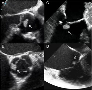 Serie de fibroelastomas pilares evaluados con ecocardiografía transesofágica en diferentes localizaciones: a nivel de la válvula aórtica (velo no coronariano, A-B), en el velo anterior de la válvula mitral (C) y en el velo septal tricuspídeo (D).
