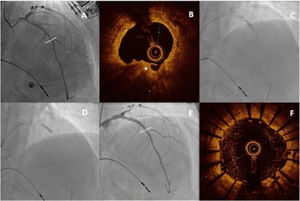 Caso realizado en el Hospital Universitario La Paz sobre una lesión gravemente calcificada en el segmento proximal de la arteria descendente anterior (A). Tras realizar aterectomía rotacional (B), al no dilatarse con éxito mediante un balón no compliante (C), se realizó litoplastia intracoronaria (D) y se implantaron dos SFA con excelente resultado tanto mediante angiografía (E) como mediante tomografía de coherencia óptica (F)43.
