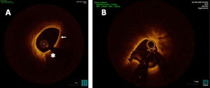 Imagen obtenida mediante tomografía de coherencia óptica. A)Placa vulnerable que muestra una cápsula fibrosa fina (flecha) y un gran contenido lipídico (asterisco). B)Placa vulnerable con rotura. Imagen cortesía de Dr. Santiago Jiménez Valero, del Hospital Universitario La Paz.