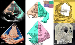 Mediciones de comunicación interventricular (CIV) muscular apical amplia. Se muestran vistas de ecocardiografía transtorácica tridimensional (ETT-3D) y de los modelos desde el ventrículo derecho (VD), evidenciando diámetros longitudinal y transverso. La adquisición volumétrica de los ventrículos se divide en 4 segmentos, representando la porción anterior y posterior y el septo interventricular. El modelo digital solo enfoca el defecto para poder ser medido. AD: aurícula derecha; AI: aurícula izquierda; AP: arteria pulmonar; D: derecha; I: izquierda; VI: ventrículo izquierdo.