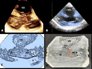 Proceso para la obtención de los modelos digital e impreso de una comunicación interventricular (CIV) infundibular subarterial amplia (asterisco). A) ecocardiografía transtorácica tridimensional (3D) en eje largo paraesternal que muestra el diámetro longitudinal y la relación con las sigmoideas aórticas. B) segmentación del defecto. C) modelo 3D digital. D) modelo impreso. Ao: aorta; VD: ventrículo derecho; VI: ventrículo izquierdo.