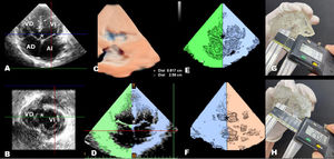 Proceso de obtención de modelos tridimensionales (3D) en el paciente con comunicación interventricular de entrada. A) diámetro longitudinal en ecocardiografía transtorácica bidimensional apical de 4 cámaras. B) diámetro transverso en eje corto paraesternal. C) vista del septo interventricular derecho, destacando el defecto sin la valva septal de la tricúspide. D) segmentación para delimitar bordes del defecto. E y F) modelo digital optimizado en vistas de 4 cámaras y septo derecho. G y H) medición longitudinal y transversal en el modelo impreso usando un Vernier. AD: aurícula derecha; AI: aurícula izquierda; VD: ventrículo derecho; VI: ventrículo izquierdo.