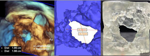 Panel izquierdo: reconstrucción volumétrica ecocardiográfica de una comunicación interventricular trabecular alta desde la vista de superficie de septo izquierdo. Modelo digital (panel central) e impreso (panel derecho), se observa una diferencia entre las mediciones del diámetro transverso de entre la ecocardiografía transtorácica tridimensional y el modelo impreso, consideramos debido a la forma irregular del defecto. Ao: aorta.