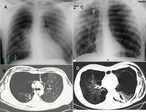 (A) Preoperative chest radiograph. Right hemithorax hyperlucency with absent vascular markings in the upper field and partially in the lower field. A horizontal line corresponding to the visceral pleura is seen in the lower field (arrows) and appeared after the placement of a chest drainage. (B) CT image, axial view. Compressed right upper lobe bullae by iatrogenic pneumothorax and paraseptal and centroacinar emphysema in the left upper lobe. Mediastinal and subcutaneous emphysema are noted. (C) A complete left pneumothorax and a bulla with mediastinal shift toward the right side is seen. (D) CT image, axial view. Left pneumothorax, ipsilateral compressed upper lobe bulla and paraseptal and centroacinar emphysema in the remaining ipsilateral and contralateral lung. Subcutaneous emphysema and a left sided chest tube are seen. Atelectatic lung, presumably the left lower lobe, is visible.