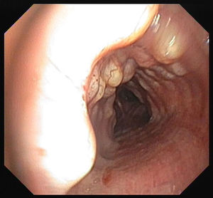 Bronchoscopic view of cartilaginous nodules on anterior and lateral tracheal walls.