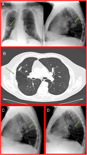A. Poster-anterior and lateral chest radiograph. 7cm pulmonary mass. B. CT scan. Centrolobular emphysema with cystic cavities in the right upper lobe. C. Lateral chest radiograph. Clear decrease in the density of the pulmonary mass. D. Lateral chest radiograph. Complete disappearance of lung mass.