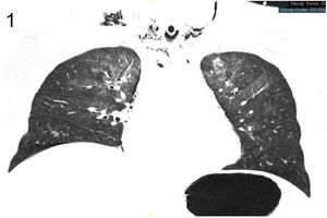 Coronal computed tomography (CT) image shows the subcutaneous emphysema of the upper and lower fossa of bilateral clavicle.