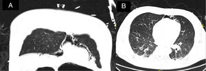 Coronal (A) and axial (B) CT images showing pneumomediastinumthe.