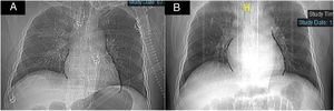 Posteroanterior CT images showing (A) the Earth-Heart sign: the cardiac silhouette appears to be flattened which is similar to an oblate sphere; and (B) normal cardiac silhouette on 5th day after re-tracheal incision.