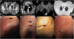 Parts A, B, C and D contain chest CT scans for cases 1, 2, 3 and 4, respectively. White arrows indicate the tracheal diverticulum. Parts E, F, G and H show fibrobronchoscopy scans for cases 1, 2, 3 and 4, respectively. Black arrows indicate the connection of the tracheal diverticulum with the tracheal lumen.