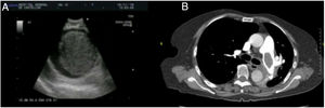 A) Imagen ecográfica de trombo en la arteria pulmonar izquierda. B) Imagen de angio-TC con émbolo en la arteria pulmonar izquierda.
