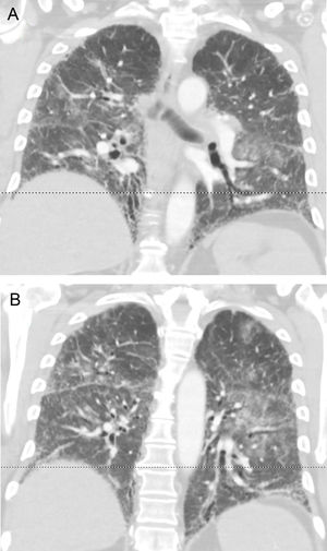 Coronal CT images. A, B. Diffuse ground glass opacities are seen on a background of traction bronquiectasias and some honeycomb areas.
