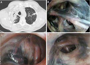 (A) Axial cut of chest computed tomography scan showed extensive consolidation in right upper lobe, with bronchial distortion; bilateral micronodular pattern, especially in upper lobes. (B–D) Flexible bronchoscopy showed bilateral anthracosis, mostly marked in right upper lobe bronchus (B) and right lower lobe bronchus (C), with endobronchial distortion, and left upper lobe bronchus (D).