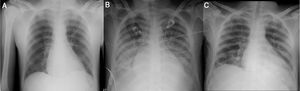 Evolution of radiological course. CxR in emergency departmente admission (A), on ICU admission (B) and at discharge (C).
