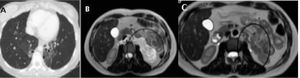 A: TC torácica. Bronquiectasias centrales y lobares de predominio en ambos LLII de aspecto quístico en LII con pérdida de volumen asociado. B: RMN de abdomen. Lesión retroperitoneal de al menos 80×95mm (T×L), hiperintensa en pT2 con presencia de tabiques en su interior y zonas con restricción de difusión y captación de contraste que sugieren componente sólido. C: RMN de abdomen. Práctica resolución de la masa quística retroperitoneal, con tamaño actual de unos 12×35×34mm.