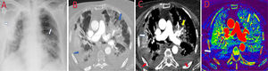 (A) Chest X-ray with single anteroposterior projection, performed the admission day, showed bilateral diffuse opacities secondary to COVID-19 pneumonia (white arrows). (B) Transverse CT images with lung window shows multiples diffuse parenchymal ground glass opacities and consolidations, typical of COVID-19 pneumonia (blue arrows). (C) Transverse CT images with mediastinal window shows posterior bilateral pleural effusion (red arrows) and bilateral heterogeneous lung consolidations (white arrows). Left central consolidation shows low contrast uptake (yellow arrow). (D) Iodine map images confirmed a central area of decreased perfusion (yellow arrow) in the left superior lobe, compatible with pulmonary superinfection confirmed later with bronchoalveolar lavage (Pseudomonas Aeruginosa).
