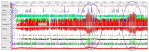 En el análisis del estudio polisomnográfico se aprecia el aumento de la presión sistólica, coincidiendo con las máximas desaturaciones durante las fases de sueño REM (círculos).DesatO2: episodios de disminución de la saturación de O2 en>4%; Flujo: flujo aéreo por sonda de presión nasal; HIPNOG: hipnograma; PLM: Periodic Limb Movement, movimientos periódicos de las extremidades. Psist: presión arterial sistólica; Pulso: frecuencia cardíaca; Ronq: ronquido; SatO2: cifras de saturación de O2.