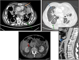 Tomografía axial computarizada (TAC) torácica y abdominopélvica tras la administración de contraste yodado intravenoso. Las imágenes del tórax y la de los riñones son cortes axiales y la de los vasos es una reconstrucción multiplanar en un plano sagital. Se aprecian los siguientes hallazgos: engrosamiento de septos interlobulillares (flecha azul); engrosamiento pleural y de cisuras, bilateral y simétrica, con mínimo derrame pleural (flecha verde); engrosamiento pericárdico con derrame (flecha naranja); engrosamiento mural difuso de las paredes de los vasos de gran y mediano tamaño, como aorta y arteria mesentérica superior (flecha curva azul) que traduce vasculitis; tejido de partes blandas en senos renales y a nivel perirrenal rodeando a la vía urinaria, sin comprimirla (flechas rojas).